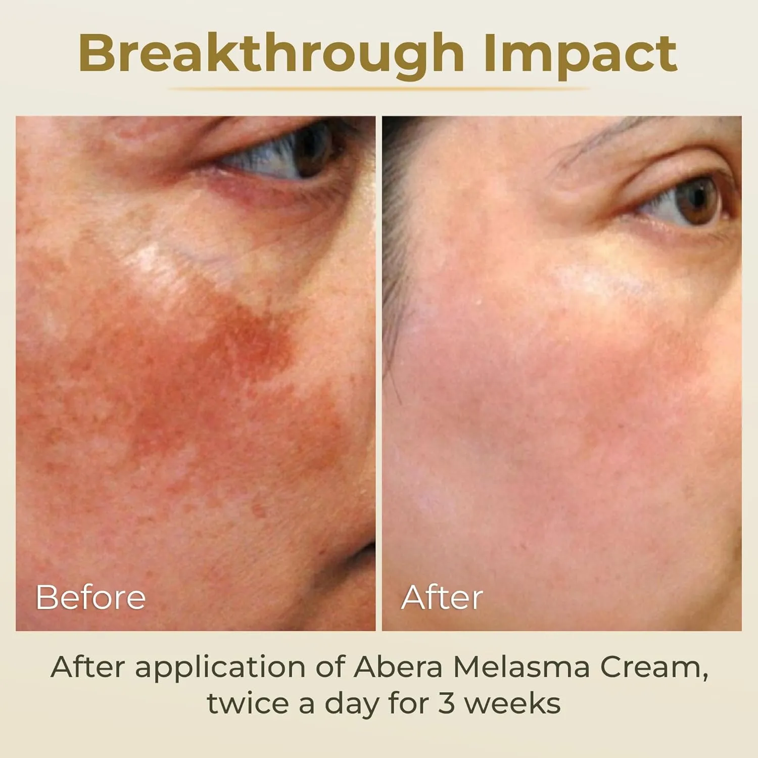 ABERA Melasma Cream (Premium Version) - Dark Spot Corrector for Age Spot Sun Spot Freckles Melasma Brown Spot, Faded Spot Correcting Cream for Face Hands